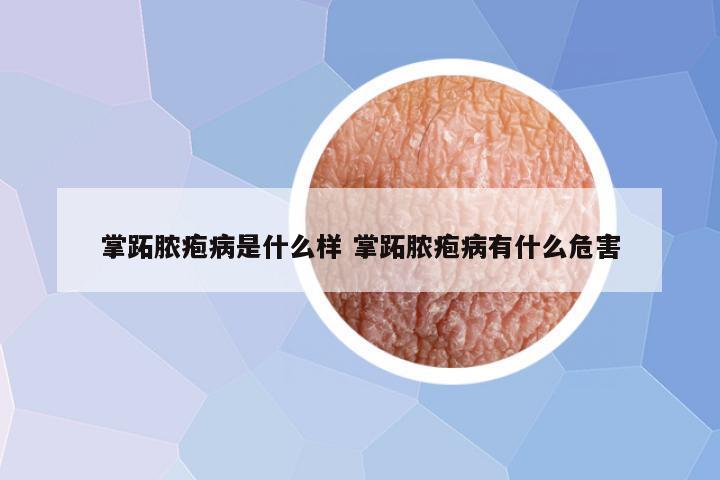 掌跖脓疱病是什么样 掌跖脓疱病有什么危害