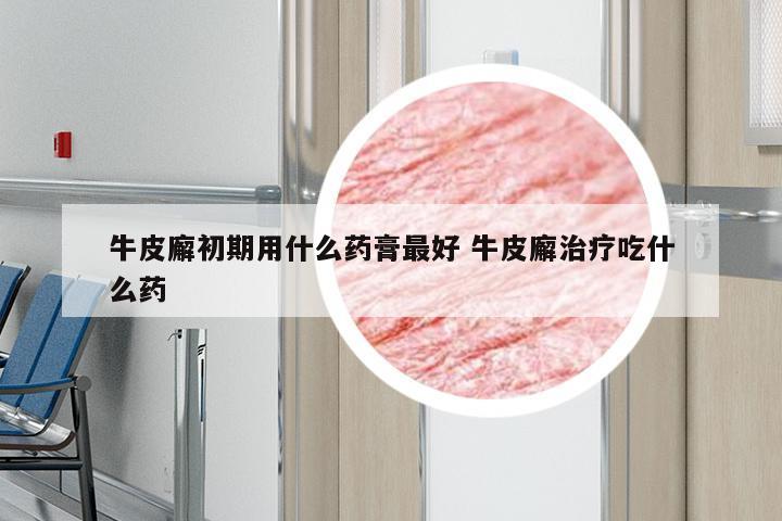 牛皮廨初期用什么药膏最好 牛皮廨治疗吃什么药