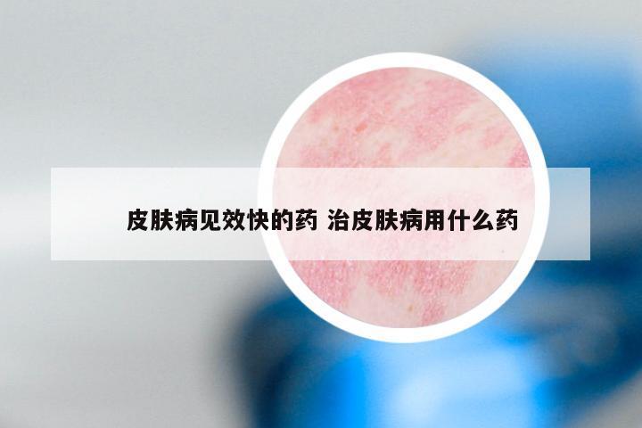 皮肤病见效快的药 治皮肤病用什么药