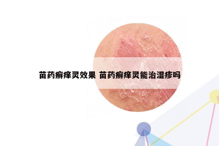 苗药癣痒灵效果 苗药癣痒灵能治湿疹吗