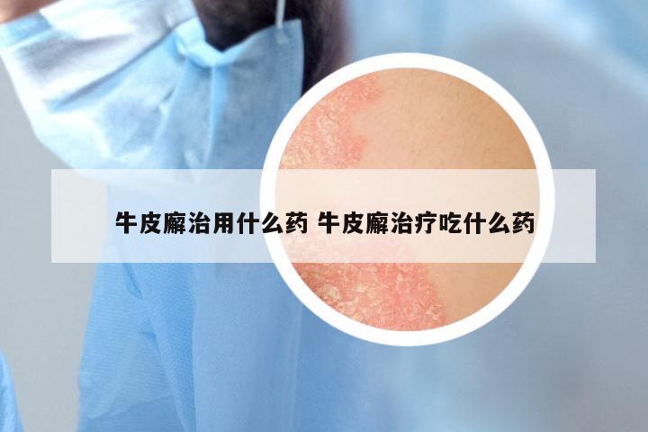 牛皮廨治用什么药 牛皮廨治疗吃什么药