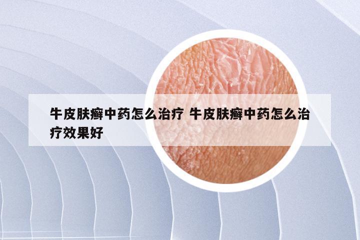 牛皮肤癣中药怎么治疗 牛皮肤癣中药怎么治疗效果好
