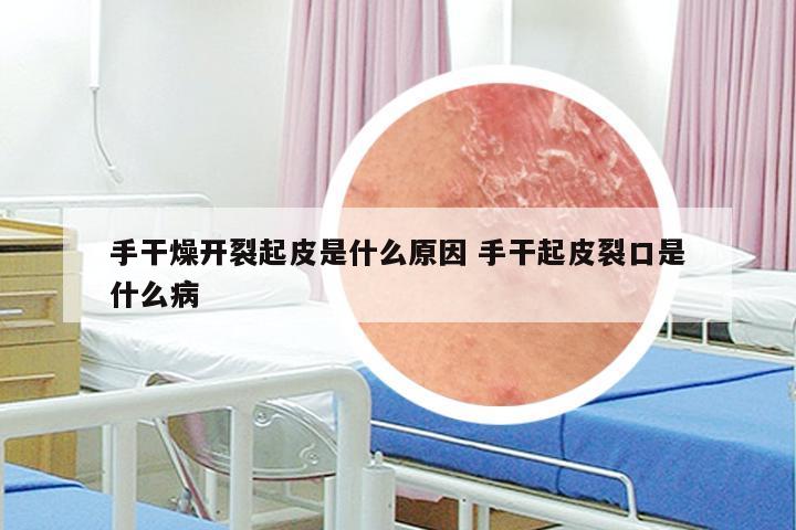 手干燥开裂起皮是什么原因 手干起皮裂口是什么病