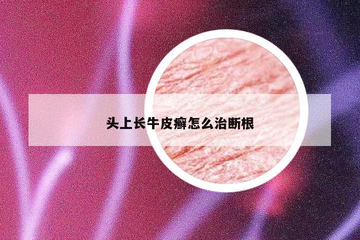 头上长牛皮癣怎么治断根