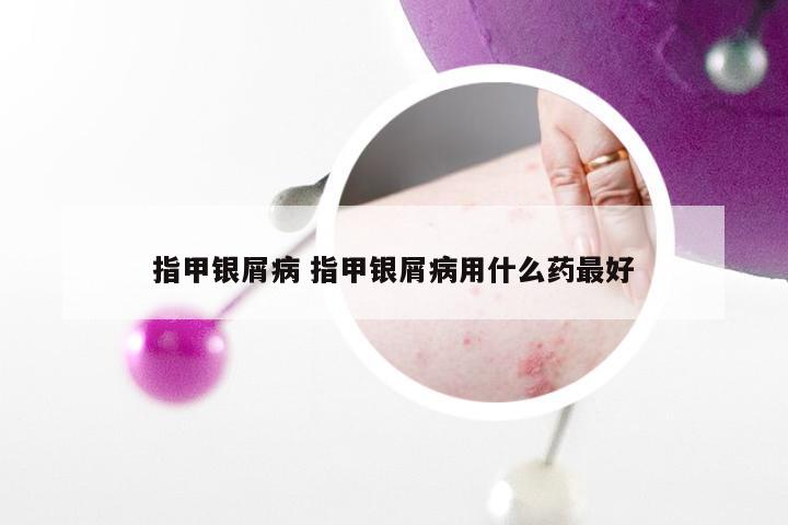 指甲银屑病 指甲银屑病用什么药最好