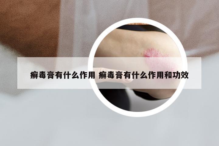 癣毒膏有什么作用 癣毒膏有什么作用和功效