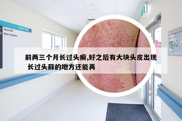 前两三个月长过头癣,好之后有大块头皮出现 长过头藓的地方还能再