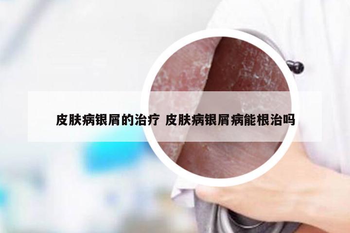 皮肤病银屑的治疗 皮肤病银屑病能根治吗
