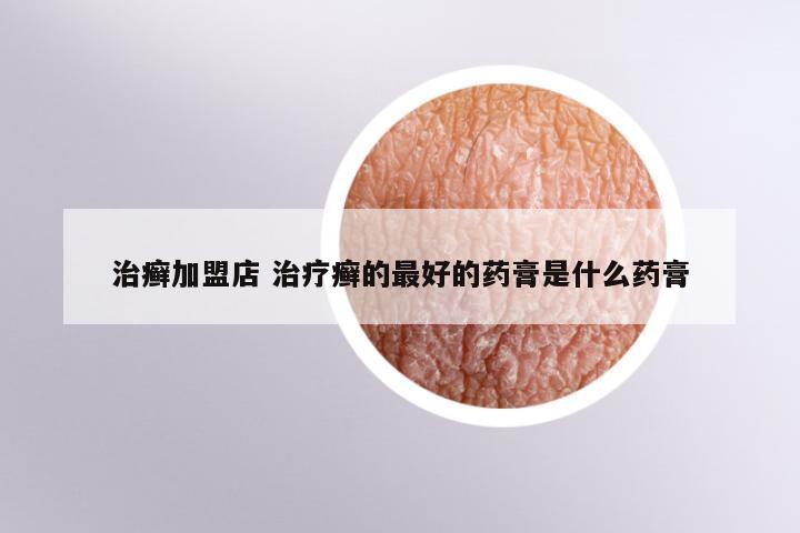 治癣加盟店 治疗癣的最好的药膏是什么药膏