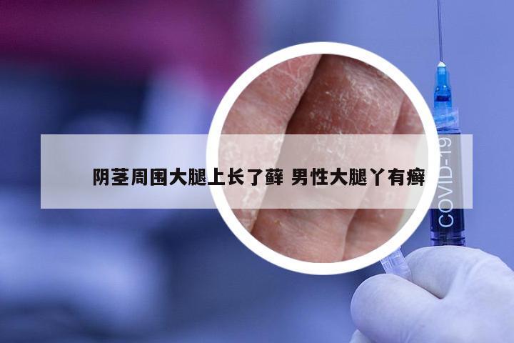 阴茎周围大腿上长了藓 男性大腿丫有癣