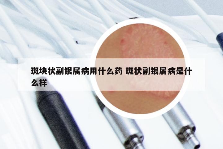 斑块状副银属病用什么药 斑状副银屑病是什么样
