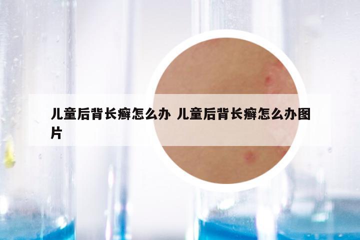 儿童后背长癣怎么办 儿童后背长癣怎么办图片