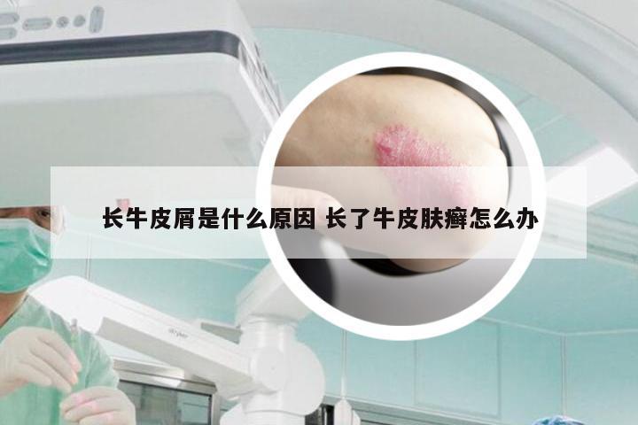 长牛皮屑是什么原因 长了牛皮肤癣怎么办