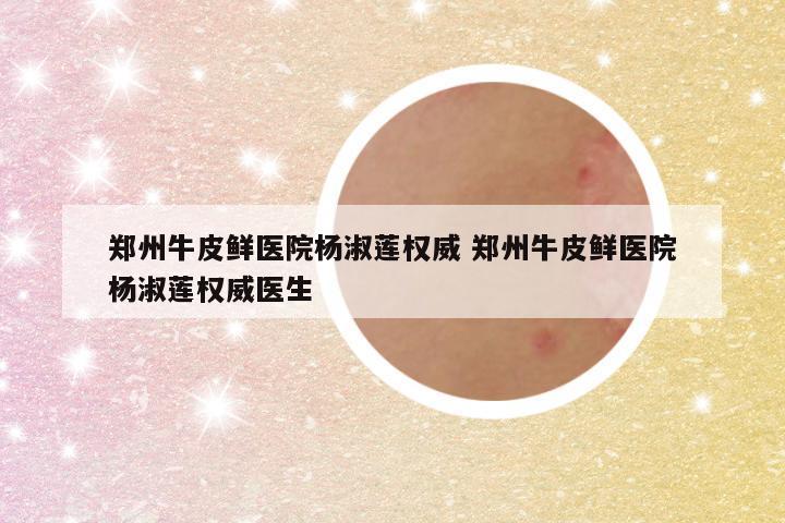 郑州牛皮鲜医院杨淑莲权威 郑州牛皮鲜医院杨淑莲权威医生