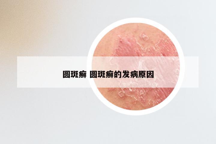 圆斑癣 圆斑癣的发病原因