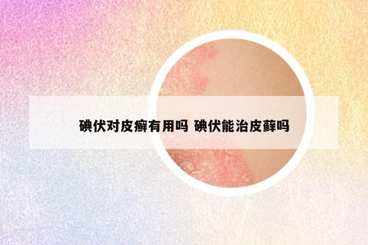 碘伏对皮癣有用吗 碘伏能治皮藓吗