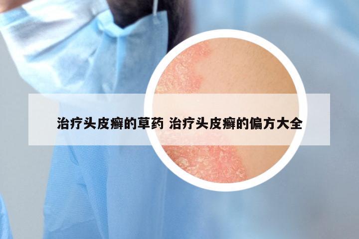 治疗头皮癣的草药 治疗头皮癣的偏方大全