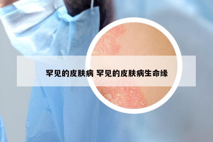 罕见的皮肤病 罕见的皮肤病生命缘