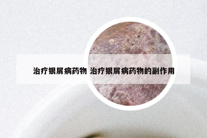 治疗银屑病药物 治疗银屑病药物的副作用