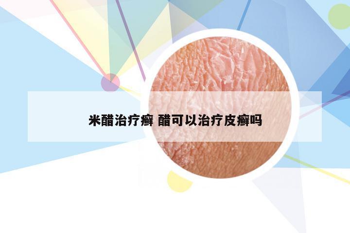 米醋治疗癣 醋可以治疗皮癣吗