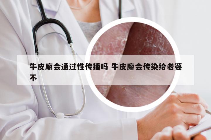 牛皮廨会通过性传播吗 牛皮廨会传染给老婆不