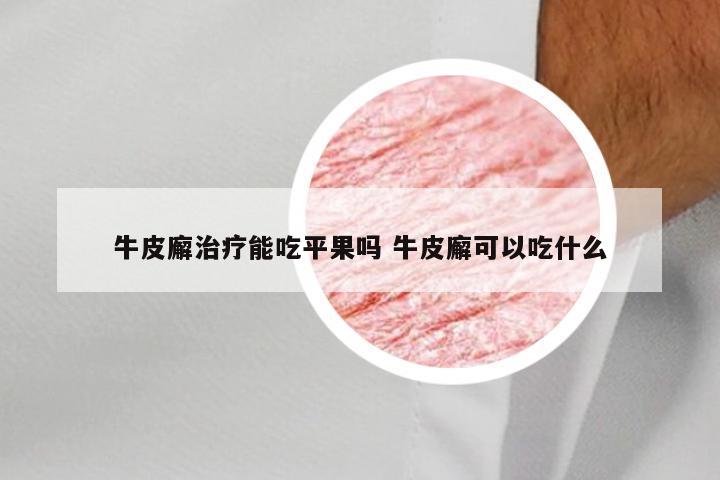 牛皮廨治疗能吃平果吗 牛皮廨可以吃什么