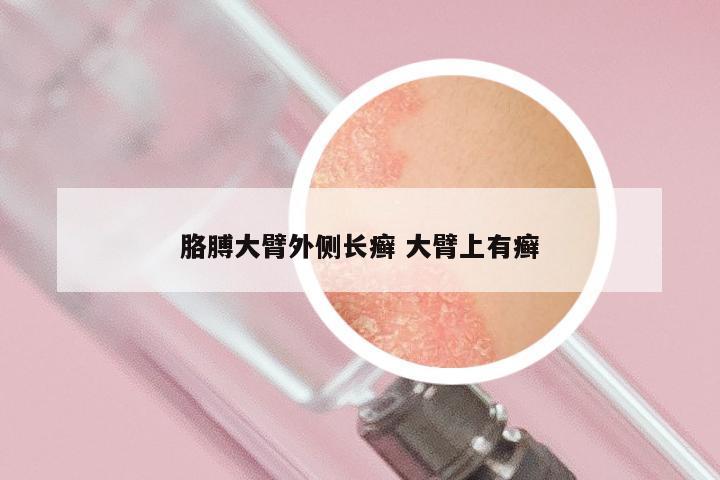 胳膊大臂外侧长癣 大臂上有癣