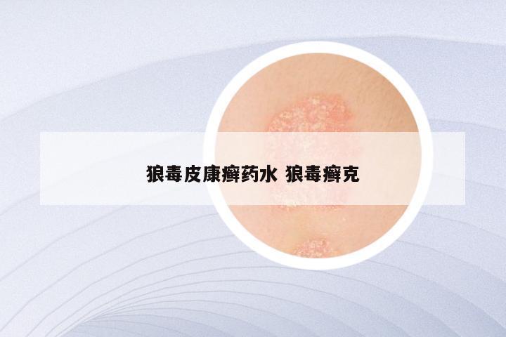 狼毒皮康癣药水 狼毒癣克