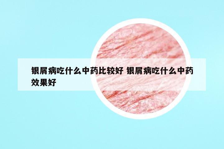银屑病吃什么中药比较好 银屑病吃什么中药效果好