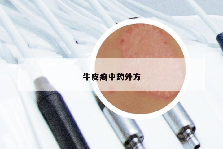 牛皮癣中药外方