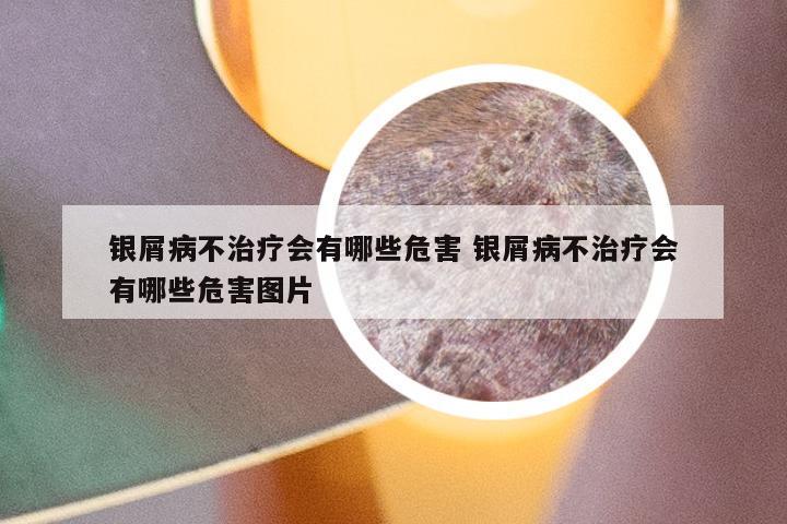 银屑病不治疗会有哪些危害 银屑病不治疗会有哪些危害图片