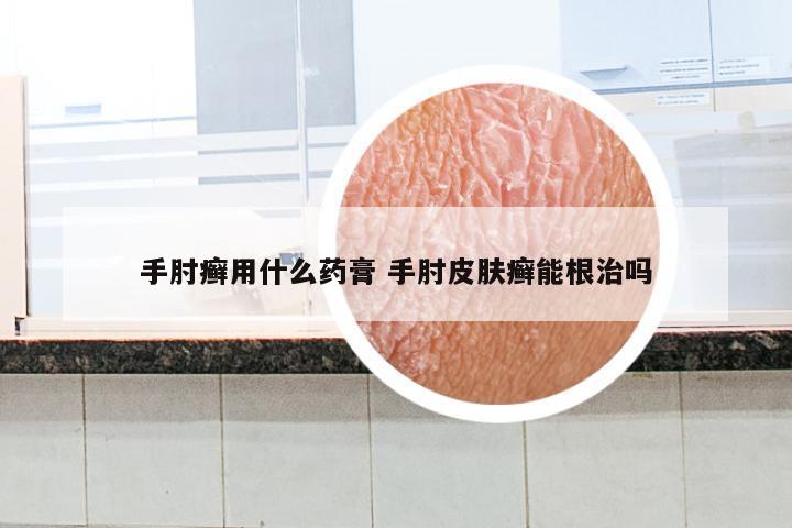 手肘癣用什么药膏 手肘皮肤癣能根治吗