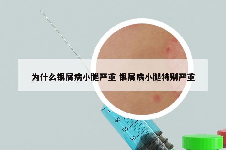 为什么银屑病小腿严重 银屑病小腿特别严重