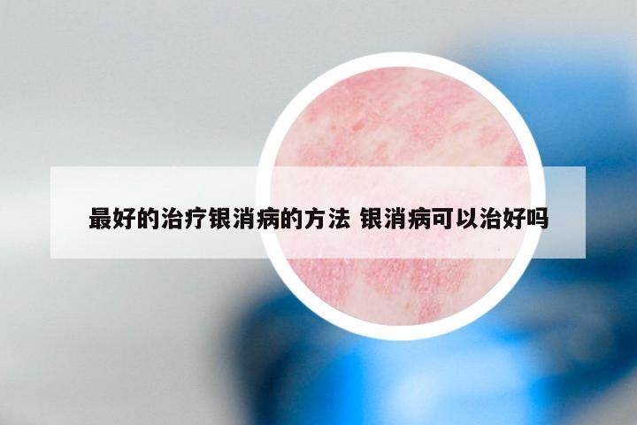 最好的治疗银消病的方法 银消病可以治好吗