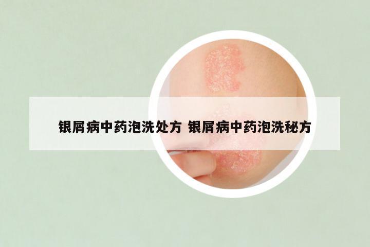 银屑病中药泡洗处方 银屑病中药泡洗秘方