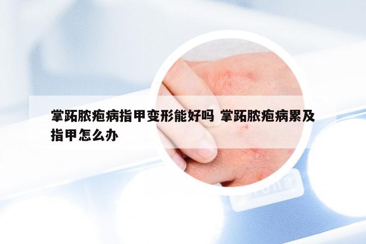 掌跖脓疱病指甲变形能好吗 掌跖脓疱病累及指甲怎么办