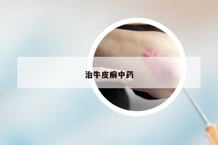 治牛皮癣中药