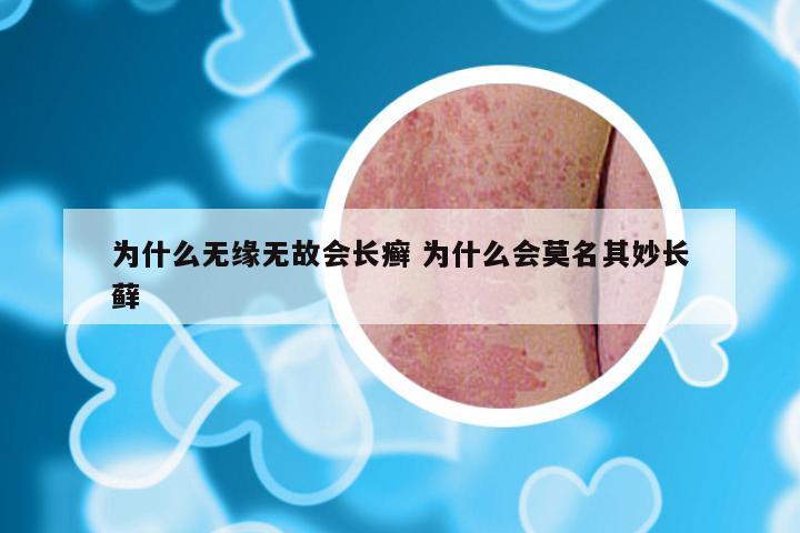 为什么无缘无故会长癣 为什么会莫名其妙长藓