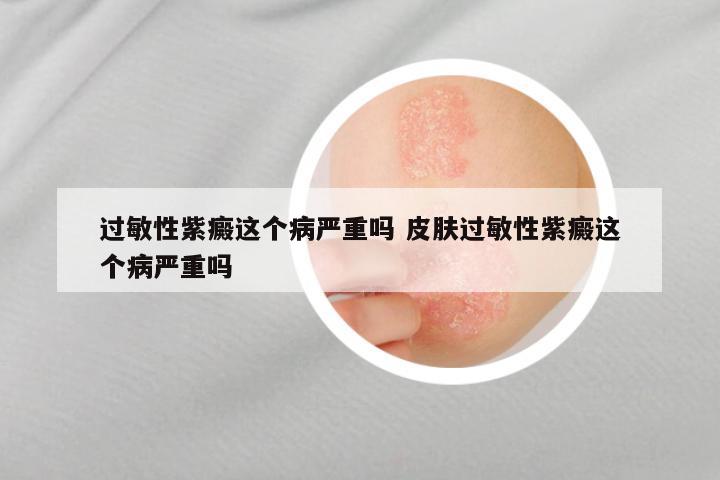 过敏性紫癜这个病严重吗 皮肤过敏性紫癜这个病严重吗