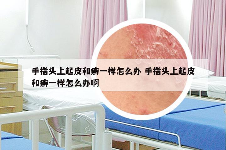 手指头上起皮和癣一样怎么办 手指头上起皮和癣一样怎么办啊