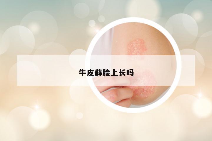 牛皮藓脸上长吗
