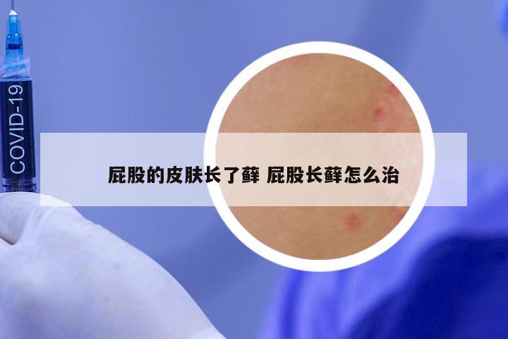 屁股的皮肤长了藓 屁股长藓怎么治