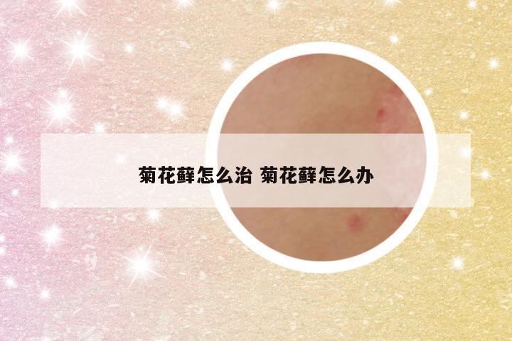 菊花藓怎么治 菊花藓怎么办