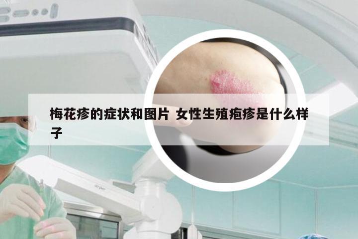 梅花疹的症状和图片 女性生殖疱疹是什么样子