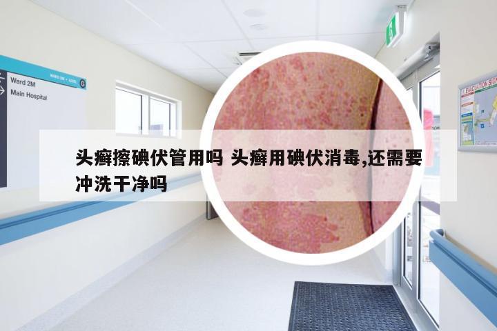 头癣擦碘伏管用吗 头癣用碘伏消毒,还需要冲洗干净吗