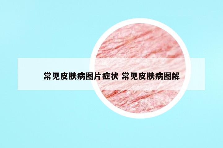 常见皮肤病图片症状 常见皮肤病图解