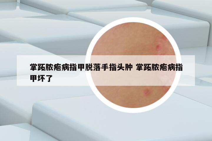 掌跖脓疱病指甲脱落手指头肿 掌跖脓疱病指甲坏了