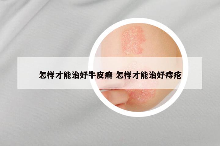 怎样才能治好牛皮癣 怎样才能治好痔疮