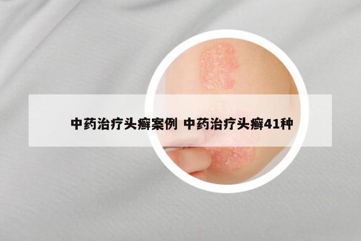 中药治疗头癣案例 中药治疗头癣41种