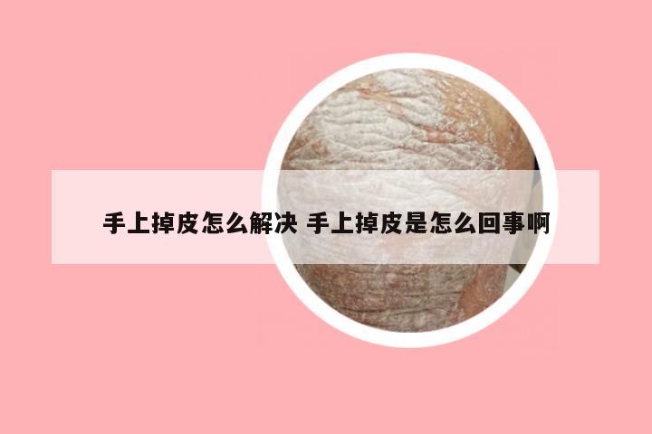 手上掉皮怎么解决 手上掉皮是怎么回事啊